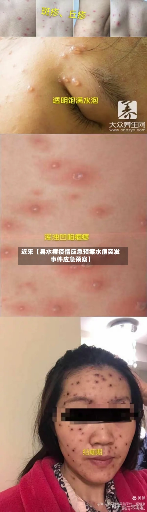 近来【县水痘疫情应急预案水痘突发事件应急预案】-第2张图片